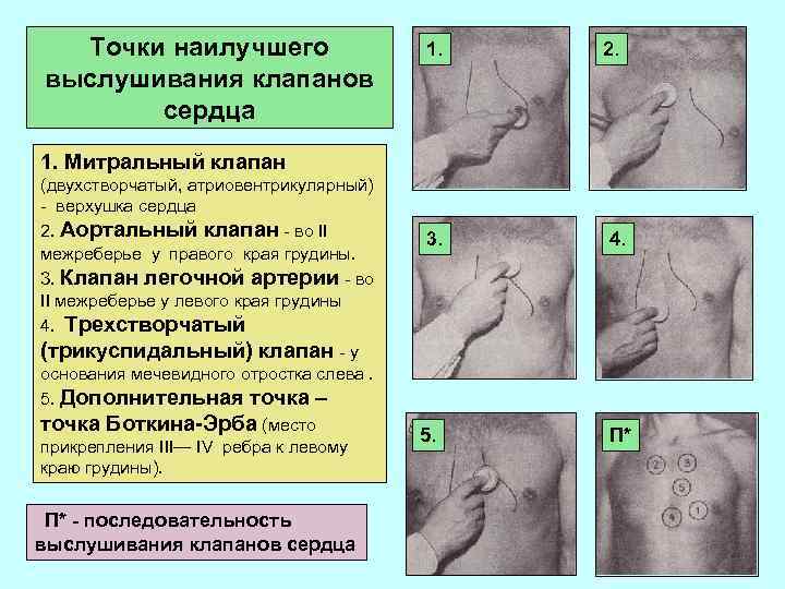 Точки наилучшего выслушивания клапанов сердца 1. 1. 2. 1. Митральный клапан (двухстворчатый, атриовентрикулярный) -