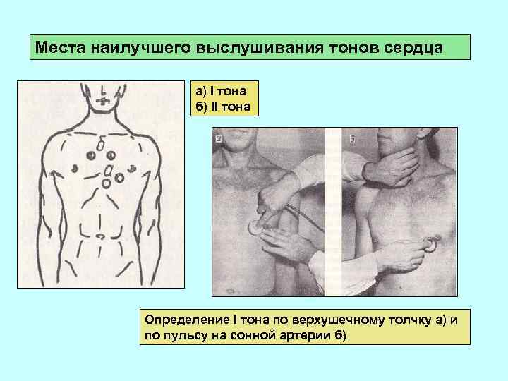 Места наилучшего выслушивания тонов сердца а) I тона б) II тона Определение I тона