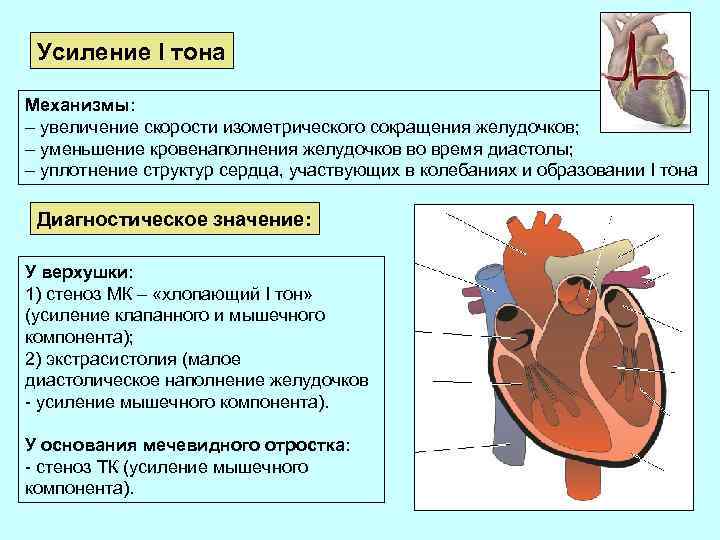 Усиление I тона Механизмы: – увеличение скорости изометрического сокращения желудочков; – уменьшение кровенаполнения желудочков