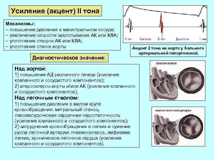 Усиление (акцент) II тона Механизмы: – повышение давления в магистральном сосуде; – увеличение скорости