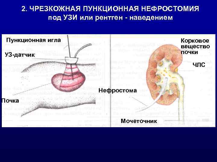 Нефростомы мкб