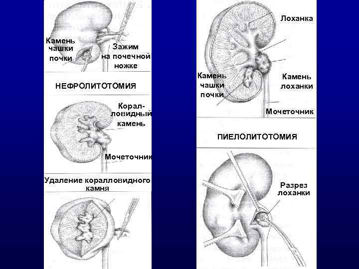 Нормы почечной лоханки