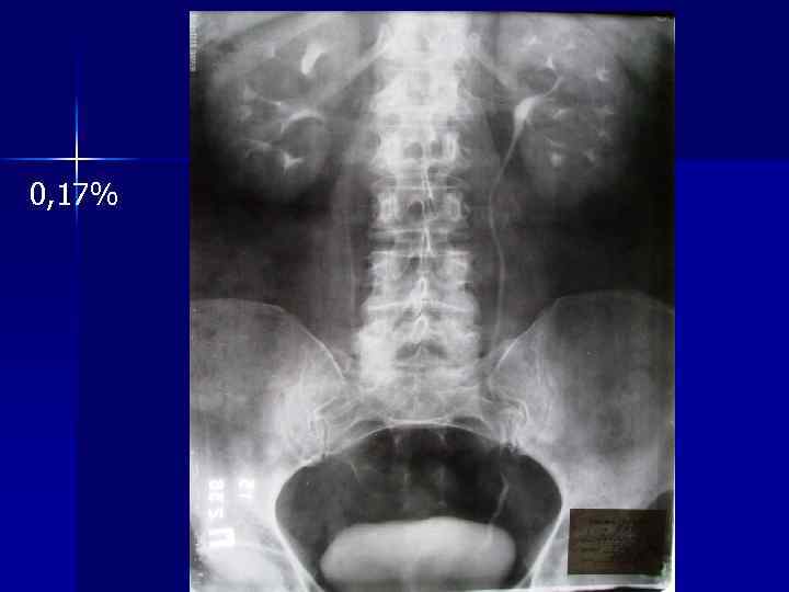 0, 17% 