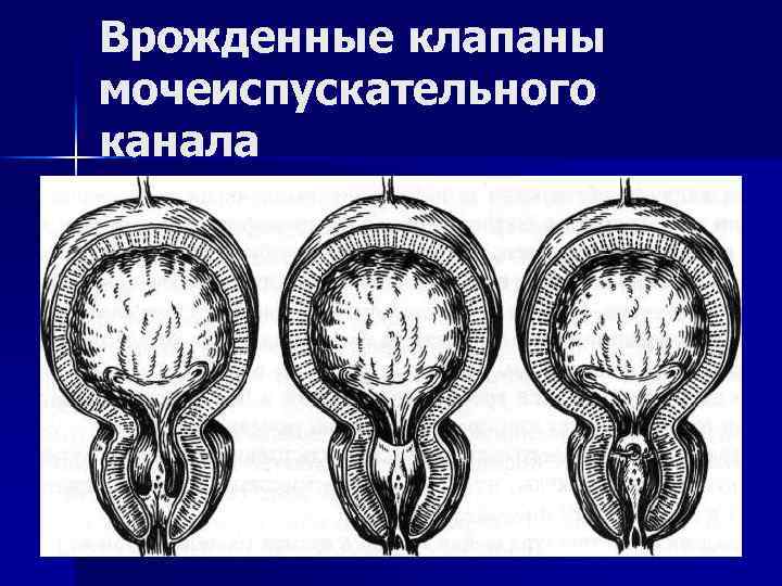 Врожденные клапаны мочеиспускательного канала 
