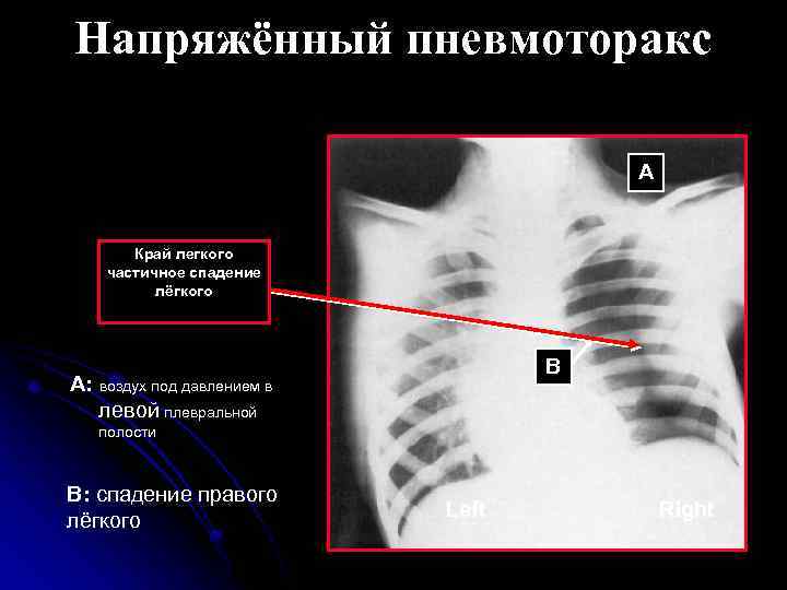 Напряжённый пневмоторакс A Край легкого частичное спадение лёгкого B A: воздух под давлением в