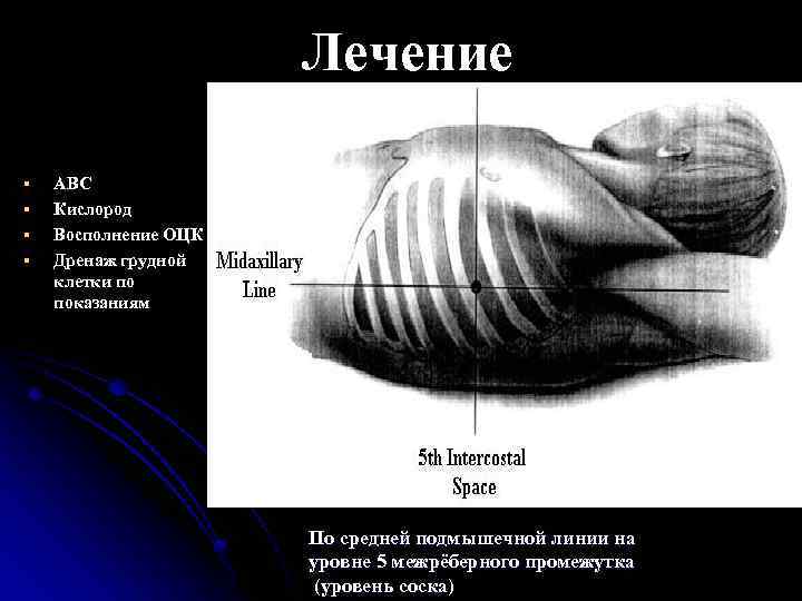 Лечение § § АВС Кислород Восполнение ОЦК Дренаж грудной клетки по показаниям По средней