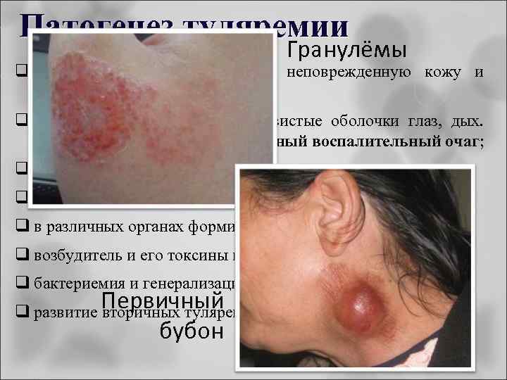 Патогенез туляремии Гранулёмы q F. tularensis проникают через неповрежденную кожу и слизистые; q на