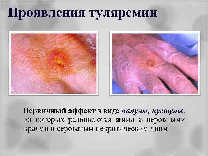 Проявления туляремии Первичный аффект в виде папулы, пустулы, из которых развиваются язвы с неровными