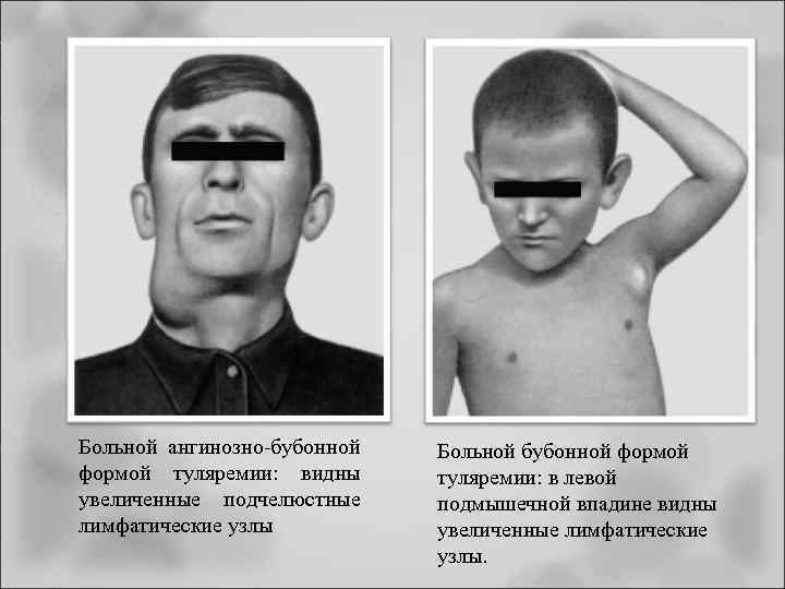 Больной ангинозно-бубонной формой туляремии: видны увеличенные подчелюстные лимфатические узлы Больной бубонной формой туляремии: в