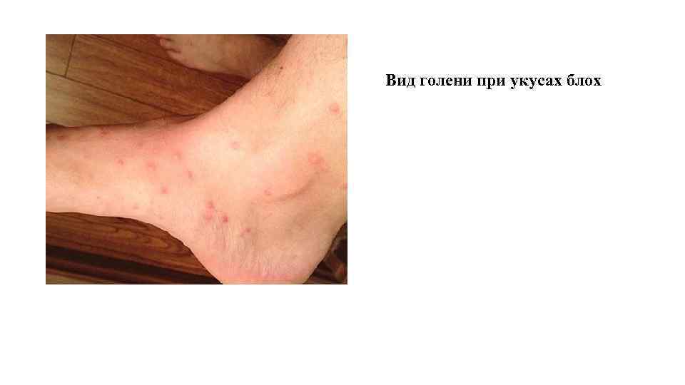 Вид голени при укусах блох 