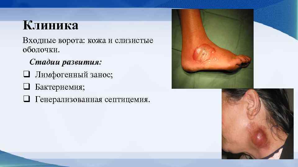 Клиника Входные ворота: кожа и слизистые оболочки. Стадии развития: q Лимфогенный занос; q Бактериемия;