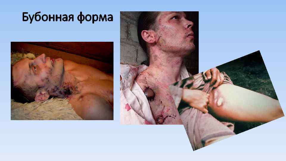 Бубонная форма 