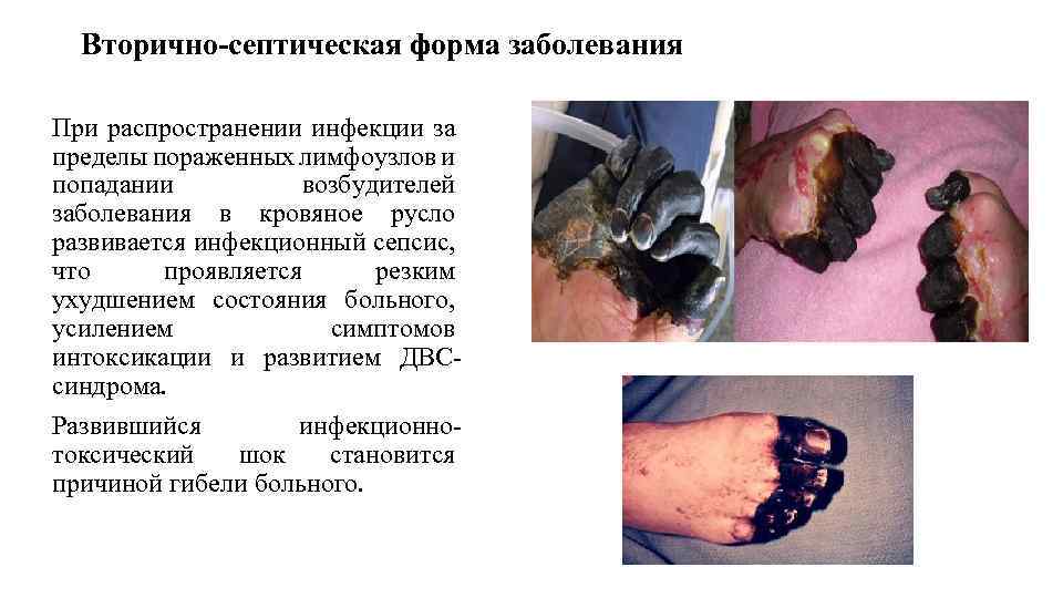 Вторично-септическая форма заболевания При распространении инфекции за пределы пораженных лимфоузлов и попадании возбудителей заболевания