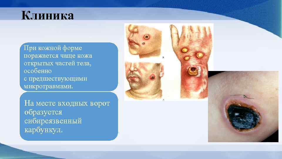 Клиника При кожной форме поражается чаще кожа открытых частей тела, особенно с предшествующими микротравмами.