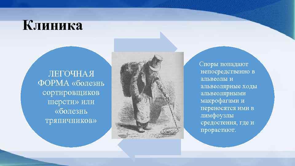 Клиника ЛЕГОЧНАЯ ФОРМА «болезнь сортировщиков шерсти» или «болезнь тряпичников» Споры попадают непосредственно в альвеолы
