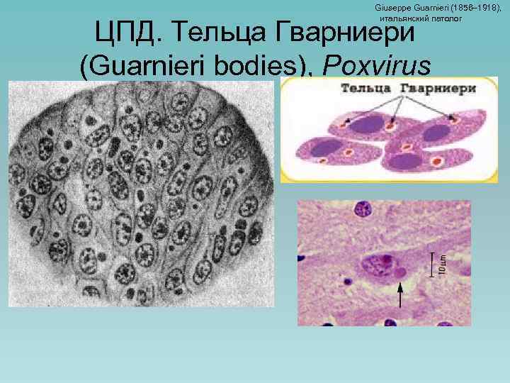 Giuseppe Guarnieri (1856– 1918), итальянский патолог ЦПД. Тельца Гварниери (Guarnieri bodies), Poxvirus 