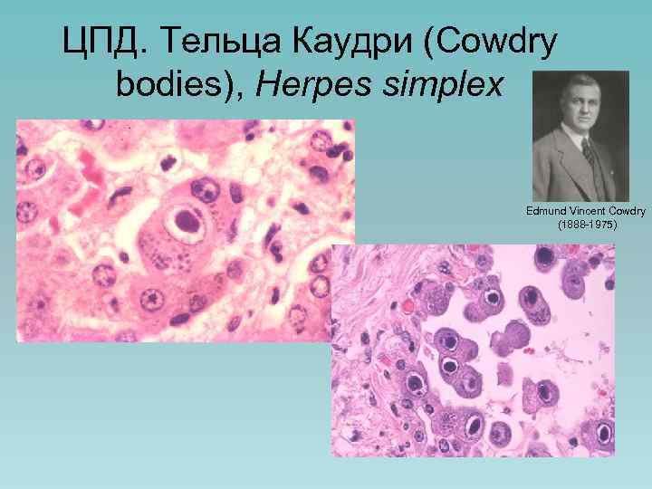 ЦПД. Тельца Каудри (Cowdry bodies), Herpes simplex Edmund Vincent Cowdry (1888 -1975) 