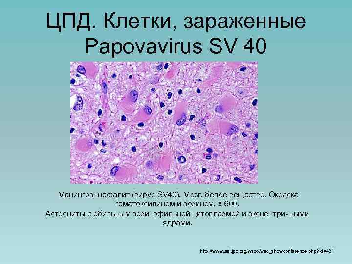 ЦПД. Клетки, зараженные Papovavirus SV 40 Менингоэнцефалит (вирус SV 40). Мозг, белое вещество. Окраска