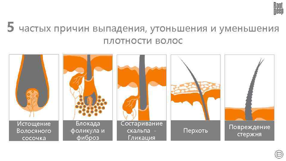 5 частых причин выпадения, утоньшения и уменьшения плотности волос Истощение Волосяного сосочка Блокада фоликула