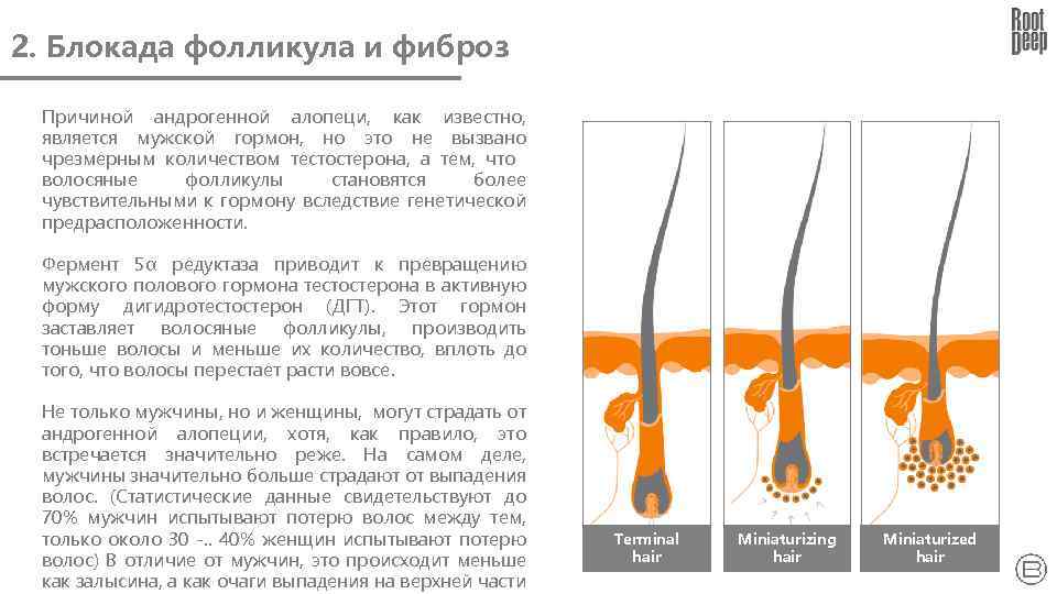 2. Блокада фолликула и фиброз Причиной андрогенной алопеци, как известно, является мужской гормон, но
