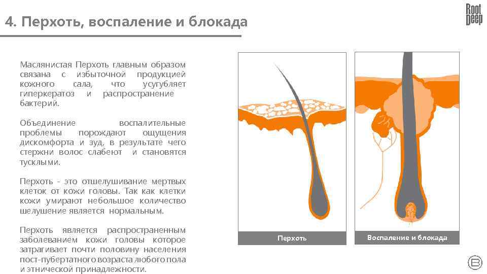 4. Перхоть, воспаление и блокада Маслянистая Перхоть главным образом связана с избыточной продукцией кожного