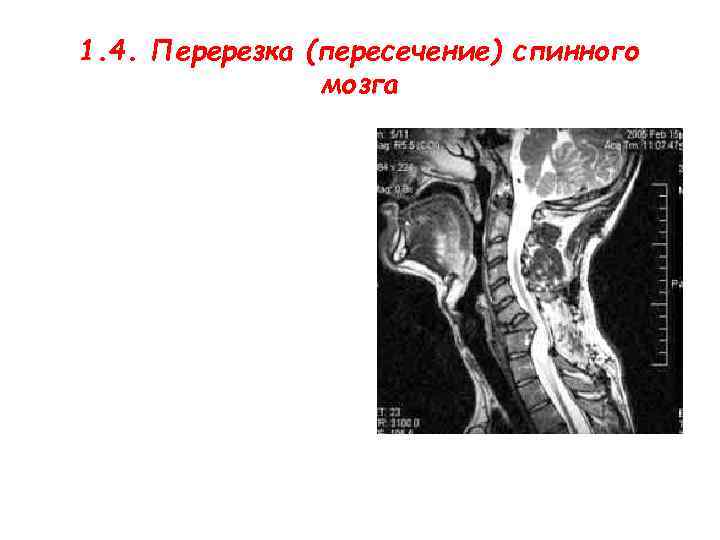 1. 4. Перерезка (пересечение) спинного мозга 