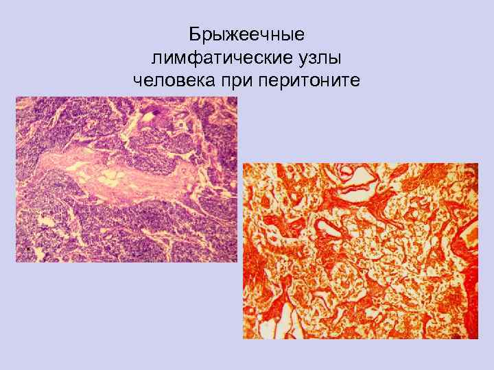 Брыжеечные лимфатические узлы человека при перитоните 