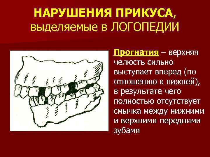 Прогения и прогнатия картинки