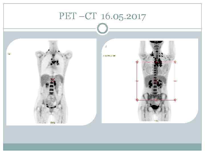 PET –CT 16. 05. 2017 