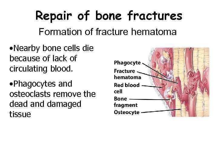 Repair of bone fractures Formation of fracture hematoma • Nearby bone cells die because