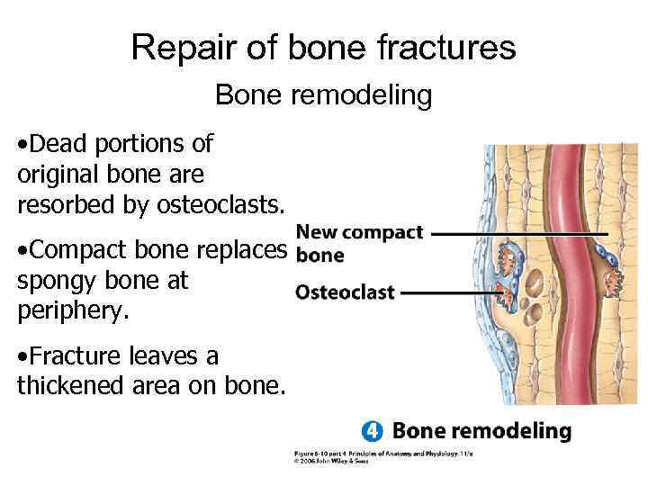 Repair of bone fractures Bone remodeling • Dead portions of original bone are resorbed
