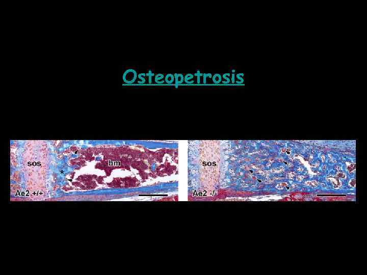 Osteopetrosis 