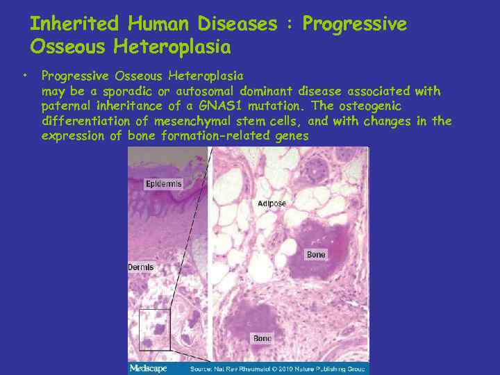 Inherited Human Diseases : Progressive Osseous Heteroplasia • Progressive Osseous Heteroplasia may be a