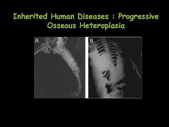 Inherited Human Diseases : Progressive Osseous Heteroplasia 