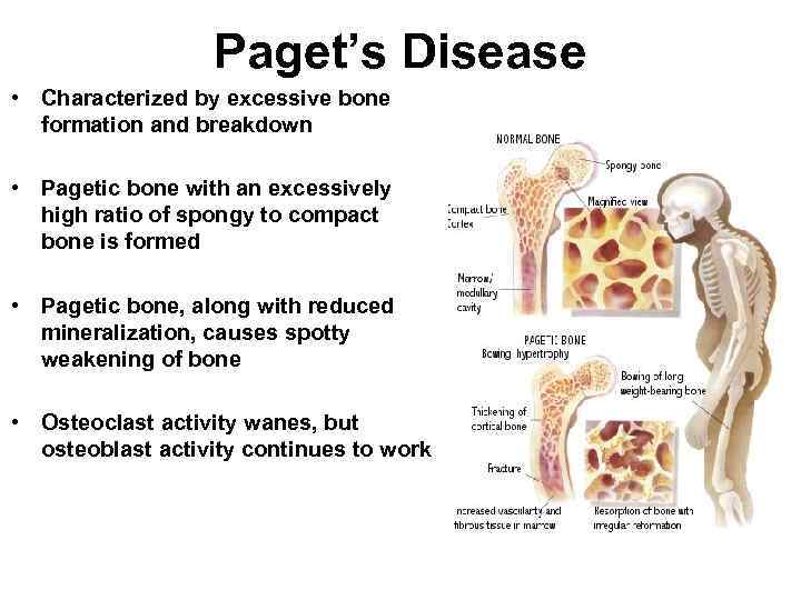 Paget’s Disease • Characterized by excessive bone formation and breakdown • Pagetic bone with