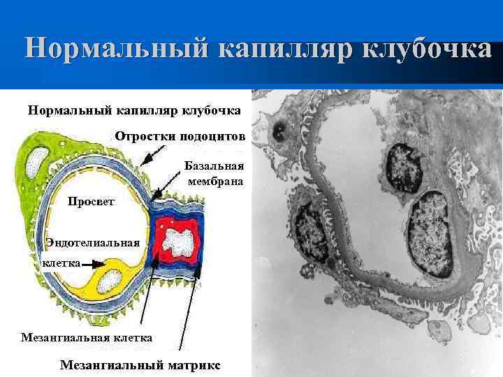 Нормальный капилляр клубочка Отростки подоцитов Базальная мембрана Просвет Эндотелиальная клетка Мезангиальный матрикс 