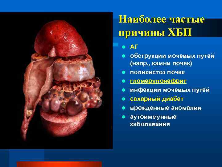 Наиболее частые причины ХБП l l l l АГ обструкции мочевых путей (напр. ,
