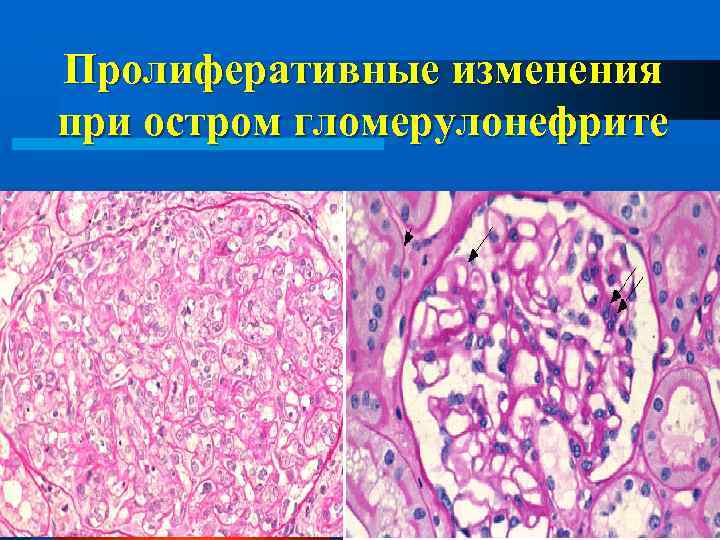 Пролиферативные изменения при остром гломерулонефрите 