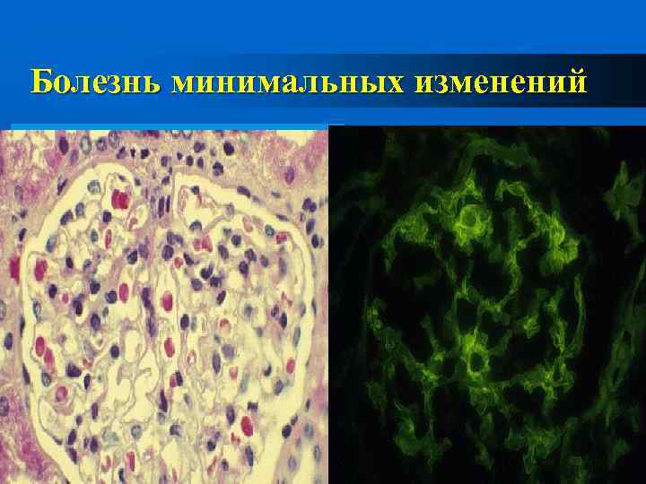 Минимальных изменений. Болезнь минимальных изменений липоидный нефроз. Критерии болезни минимальных изменений клубочков. Минимальные изменения клубочков (липоидный нефроз);. Болезнь минимальных изменений морфология.