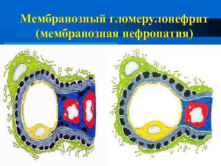 Мембранозный гломерулонефрит (мембранозная нефропатия) 