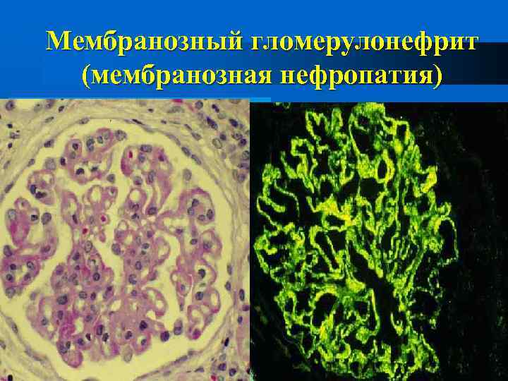 Мембранозный гломерулонефрит (мембранозная нефропатия) 