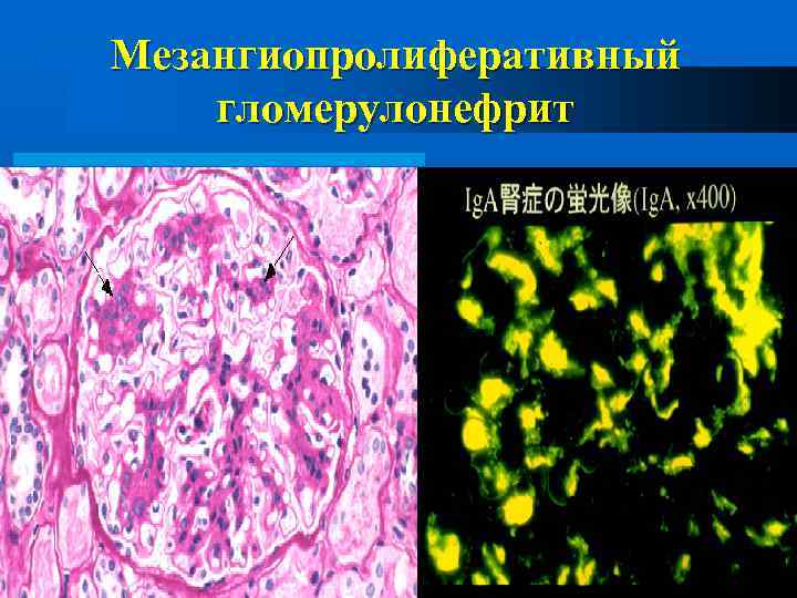 Мезангиопролиферативный гломерулонефрит 