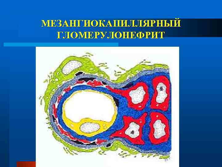 МЕЗАНГИОКАПИЛЛЯРНЫЙ ГЛОМЕРУЛОНЕФРИТ 