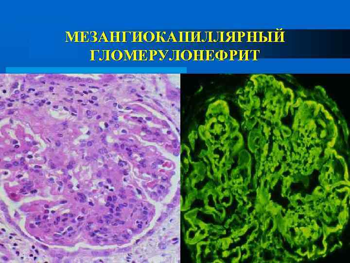 МЕЗАНГИОКАПИЛЛЯРНЫЙ ГЛОМЕРУЛОНЕФРИТ 