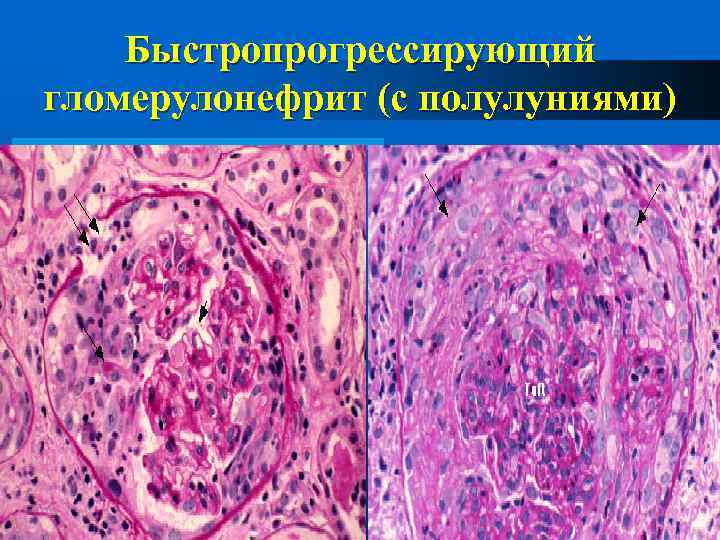 Быстропрогрессирующий гломерулонефрит (с полулуниями) 
