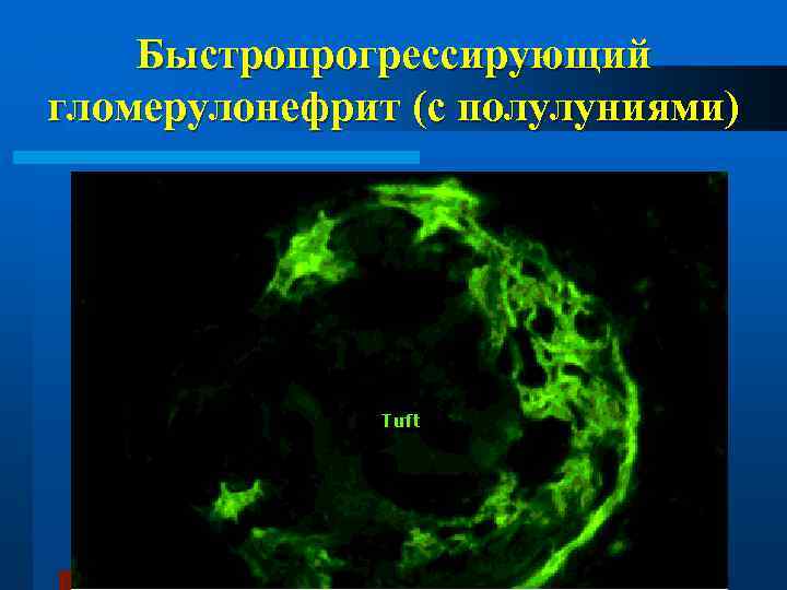 Быстропрогрессирующий гломерулонефрит (с полулуниями) 