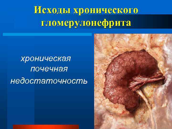 Исходы хронического гломерулонефрита хроническая почечная недостаточность 