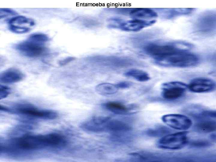 Entamoeba gingivalis 