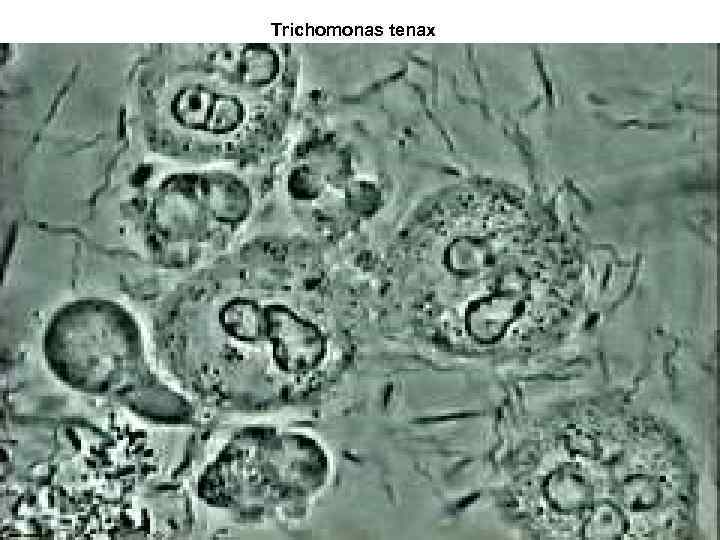 Trichomonas tenax 