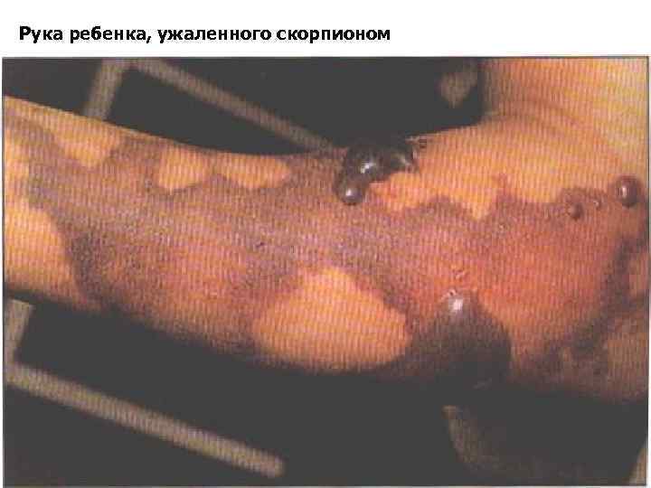 Рука ребенка, ужаленного скорпионом 